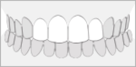 オールセラミッククラウン(1歯) (e-maxセラミック使用)4本セット